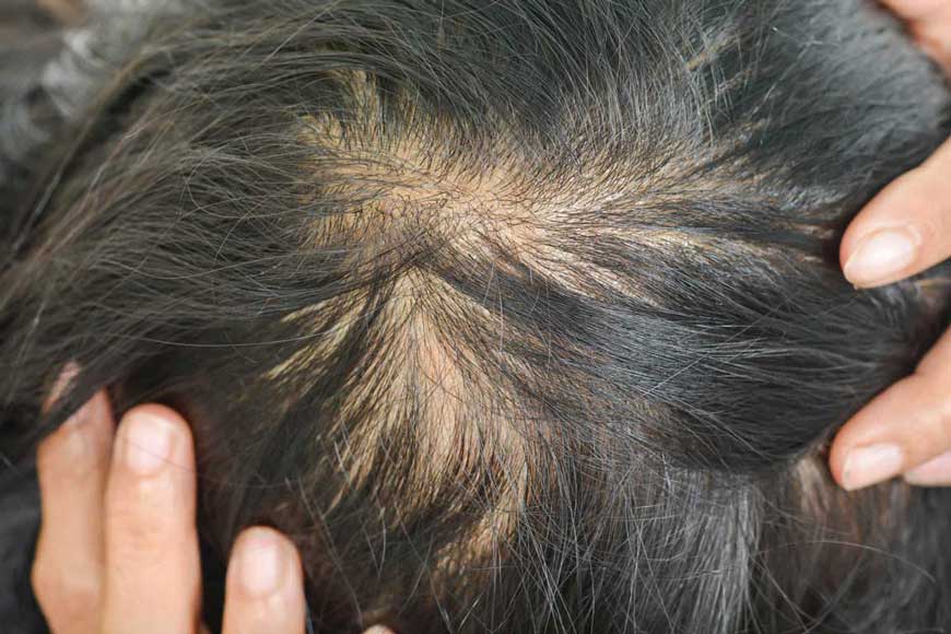 If you have female pattern hair loss, avoid these supplements.